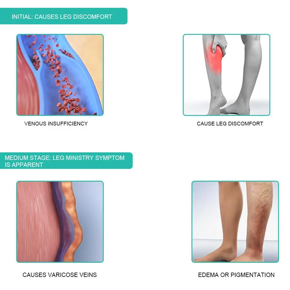 1 쌍 의료 압축 양말 30-40mmHg 중간 튜브 얇 - Compression Sleeve Calf 리뷰 및 가격